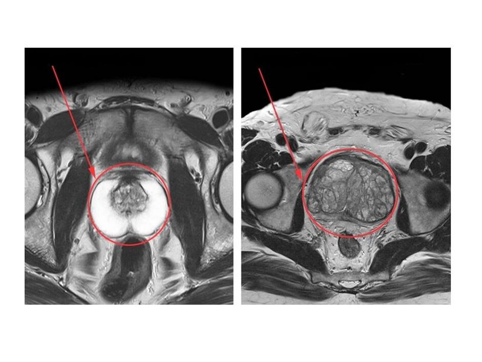Porovnání zdravé (vlevo) a zanícené (vpravo) prostaty na snímcích MRI